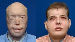 Transplant patient Patrick Hardison before and after his surgery