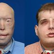 Transplant patient Patrick Hardison before and after his surgery