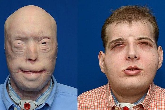 Transplant patient Patrick Hardison before and after his surgery
