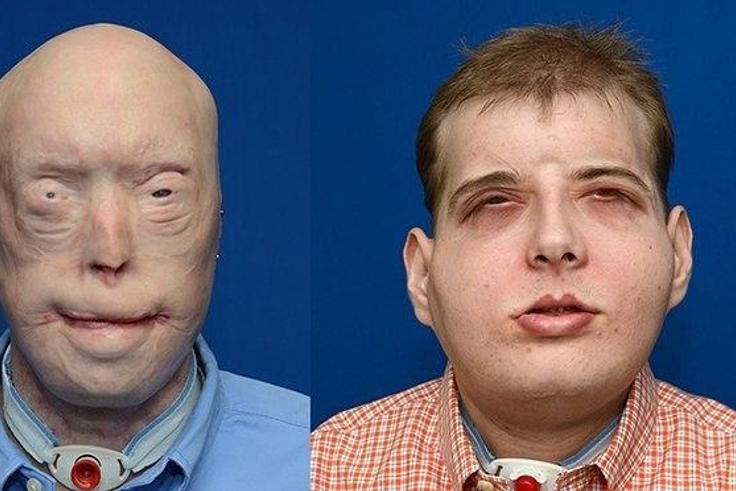 Transplant patient Patrick Hardison before and after his surgery