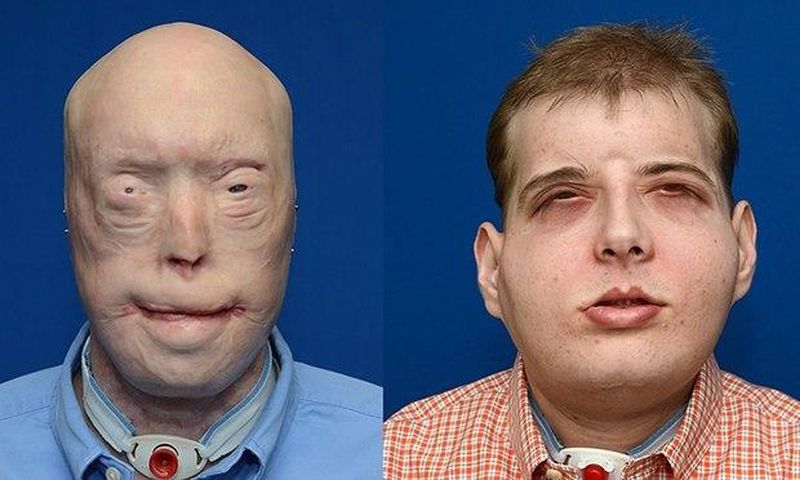 Transplant patient Patrick Hardison before and after his surgery