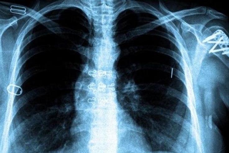 Fight against TB paying off globally, report says