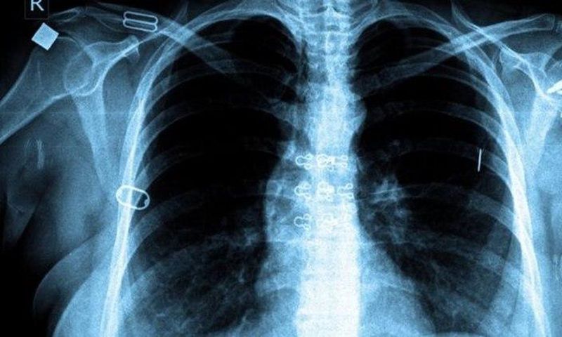 Fight against TB paying off globally, report says