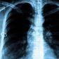 Fight against TB paying off globally, report says