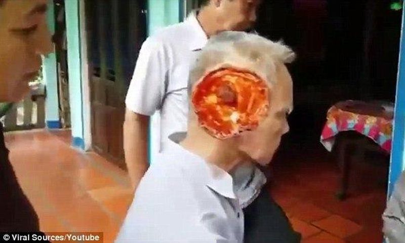 Mysterious flesh-eating virus eats away the whole of man’s face [Graphic]