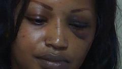 The disfigured face of Ruth Gakii