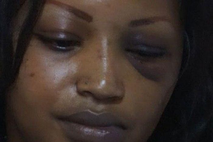 The disfigured face of Ruth Gakii