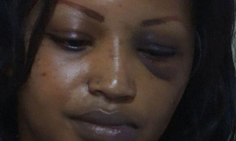 The disfigured face of Ruth Gakii