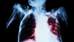 TB can affect the lungs