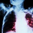 TB can affect the lungs