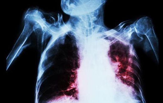 TB can affect the lungs