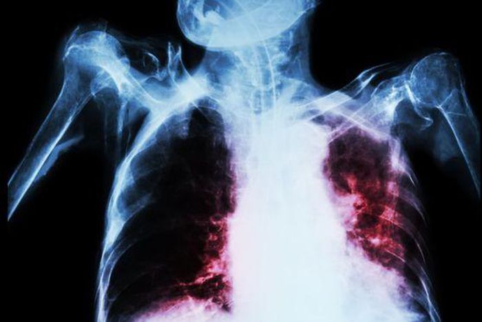 TB can affect the lungs