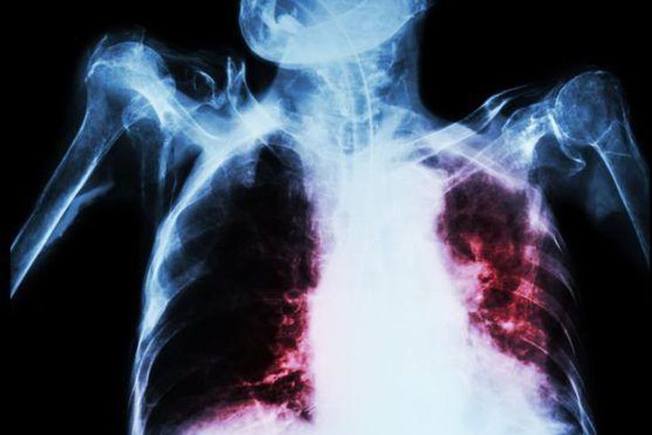 TB can affect the lungs