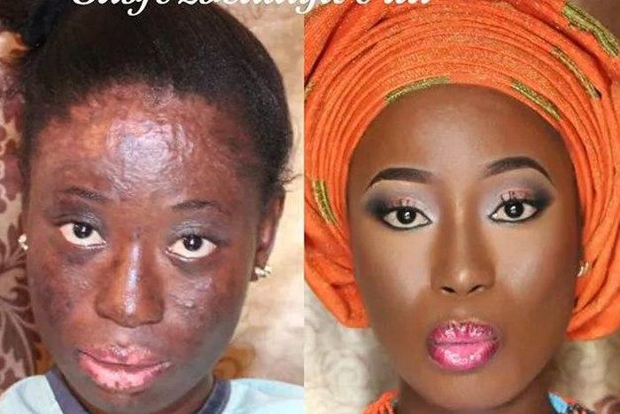 How A Makeup Artist Transformed Gas Explosion Survivor