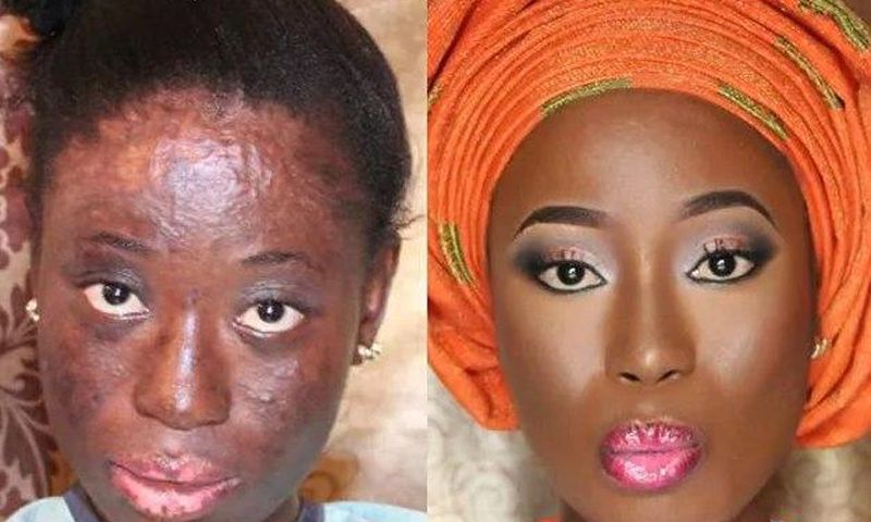 How A Makeup Artist Transformed Gas Explosion Survivor