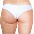Cellulite