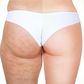 Cellulite