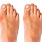 Bunion development, from mild to severe