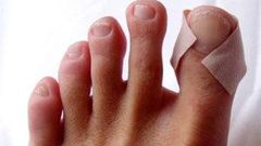 Runners blisters