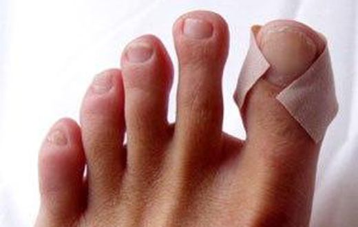 Runners blisters