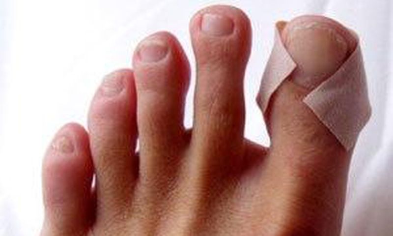Runners blisters