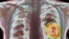___3818265___https:______static.pulse.com.gh___webservice___escenic___binary___3818265___2015___6___1___19____83308741_m1340336-coloured_x-ray_showing_lung_cancer-spl