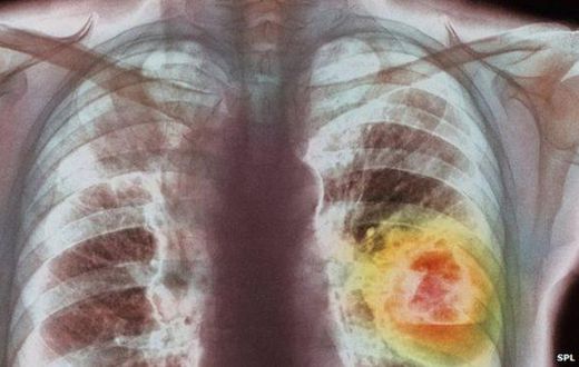 ___3818265___https:______static.pulse.com.gh___webservice___escenic___binary___3818265___2015___6___1___19____83308741_m1340336-coloured_x-ray_showing_lung_cancer-spl
