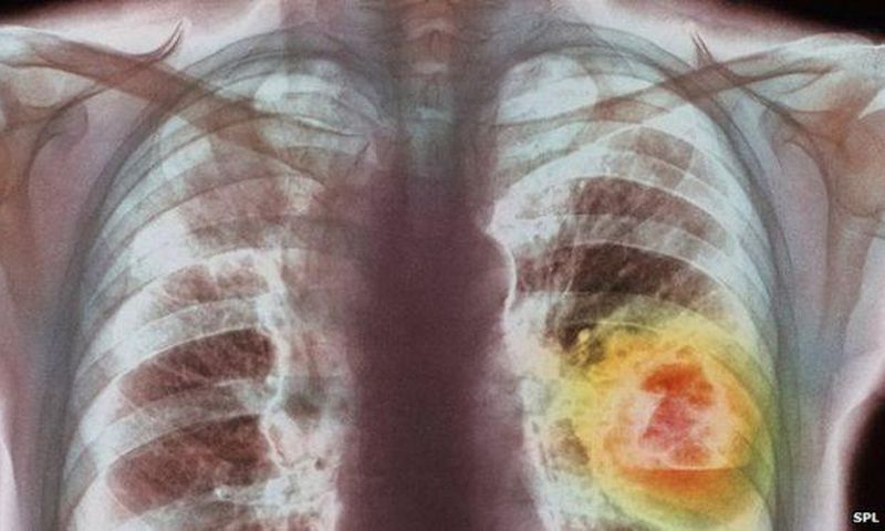 ___3818265___https:______static.pulse.com.gh___webservice___escenic___binary___3818265___2015___6___1___19____83308741_m1340336-coloured_x-ray_showing_lung_cancer-spl