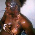 This poor girl has been disfigured by a jealous wife