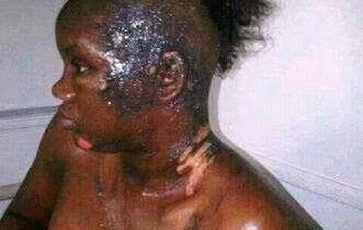 This poor girl has been disfigured by a jealous wife