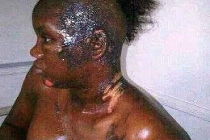 This poor girl has been disfigured by a jealous wife