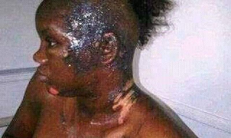 This poor girl has been disfigured by a jealous wife