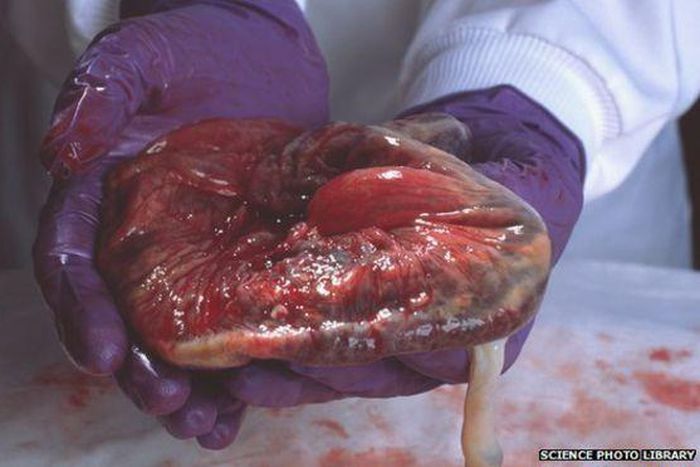 ___3833430___https:______static.pulse.com.gh___webservice___escenic___binary___3833430___2015___6___5___18____83418061_p6160317-placenta-spl