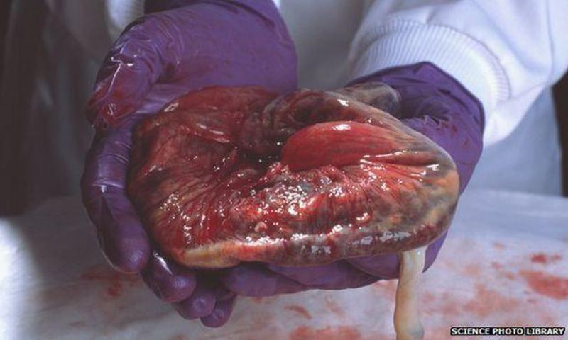 ___3833430___https:______static.pulse.com.gh___webservice___escenic___binary___3833430___2015___6___5___18____83418061_p6160317-placenta-spl