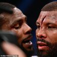 Badou Jack suffered a horrific head injury during his fight with Marcus Browne in Vegas