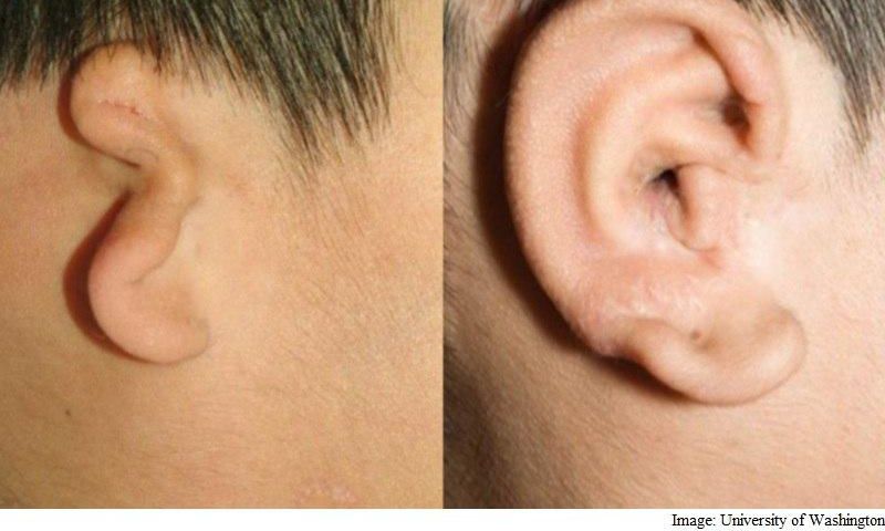 An under-developed ear replaced with a 3D printed ear