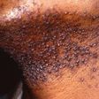 Hair bumps peculiar to African male - Expert