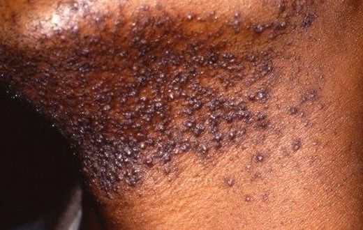 Hair bumps peculiar to African male - Expert