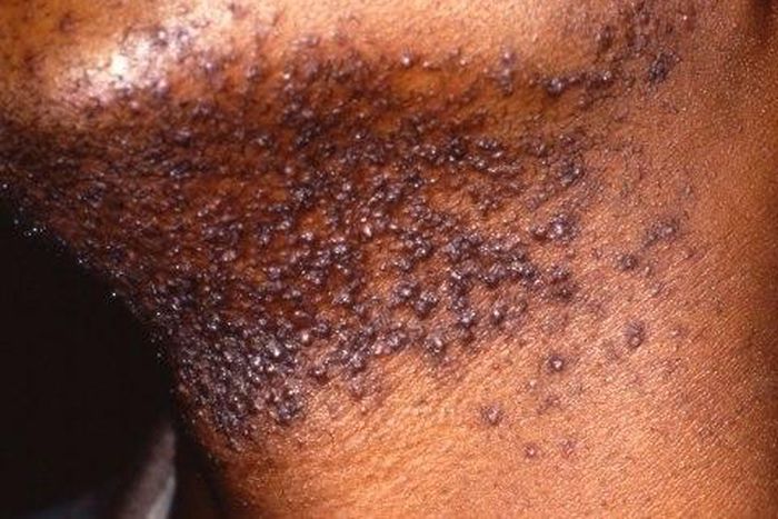 Hair bumps peculiar to African male - Expert