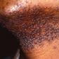 Hair bumps peculiar to African male - Expert