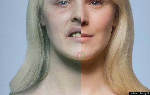 Effects of cigarette on the skin