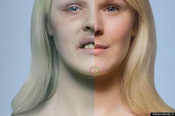 Effects of cigarette on the skin