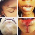 G-Unit rapper, Kidd Kidd's girlfriend's face after he allegedly beat her up