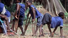 Poliomyelitis (polio) is a highly infectious viral disease, which mainly affects young children.