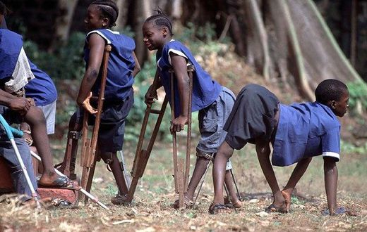 Poliomyelitis (polio) is a highly infectious viral disease, which mainly affects young children.