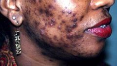 Bad case of adult acne