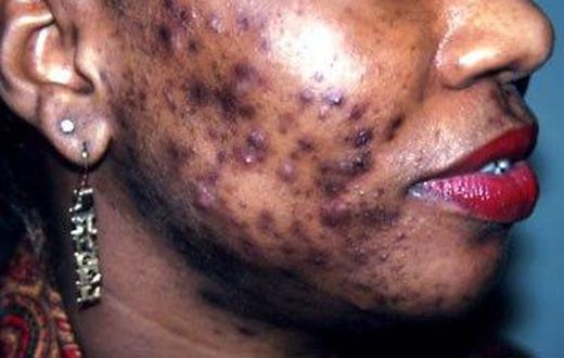 Bad case of adult acne