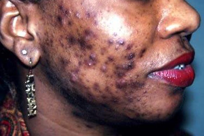 Bad case of adult acne