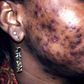 Bad case of adult acne