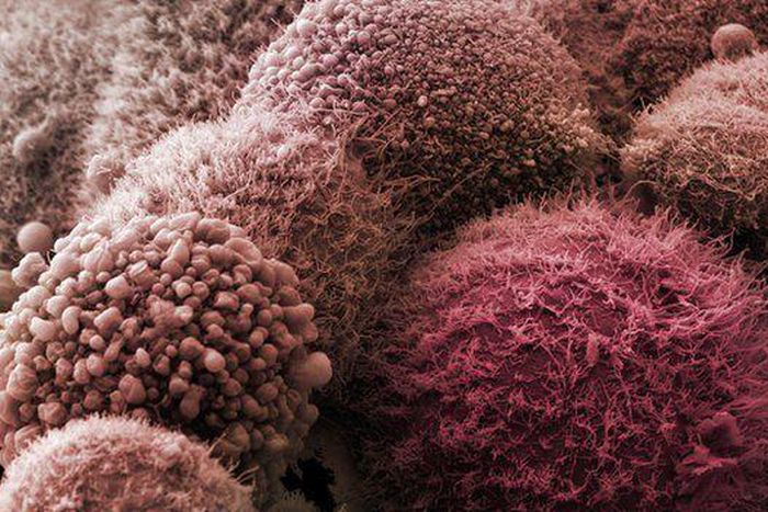 ___4035153___https:______static.pulse.com.gh___webservice___escenic___binary___4035153___2015___8___3___10____84610307_pancreatic_cancer_cells-spl_1